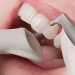 A patient’s teeth being cleaned with AIR-FLOW®