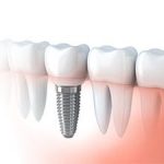 A tooth with a dental implant