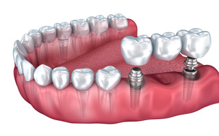 Diagram of how dental implants fit into the jaw